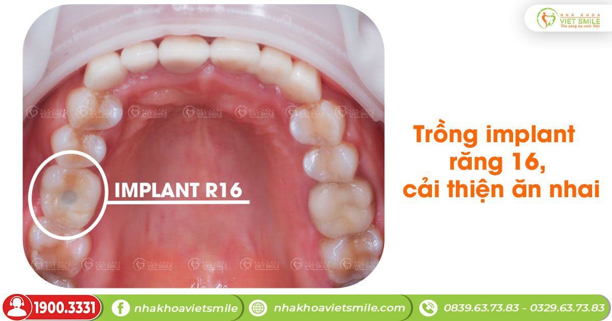 Trồng implant răng 16 cải thiện ăn nhai