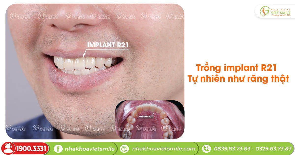 Trồng implant R21 tự nhiên như răng thật 