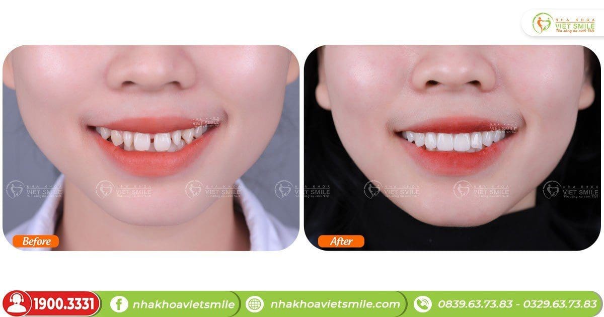 Trước và sau làm răng sứ