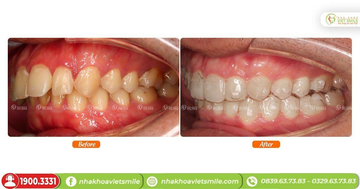 Cải thiện khuyết điểm với niềng răng trong suốt