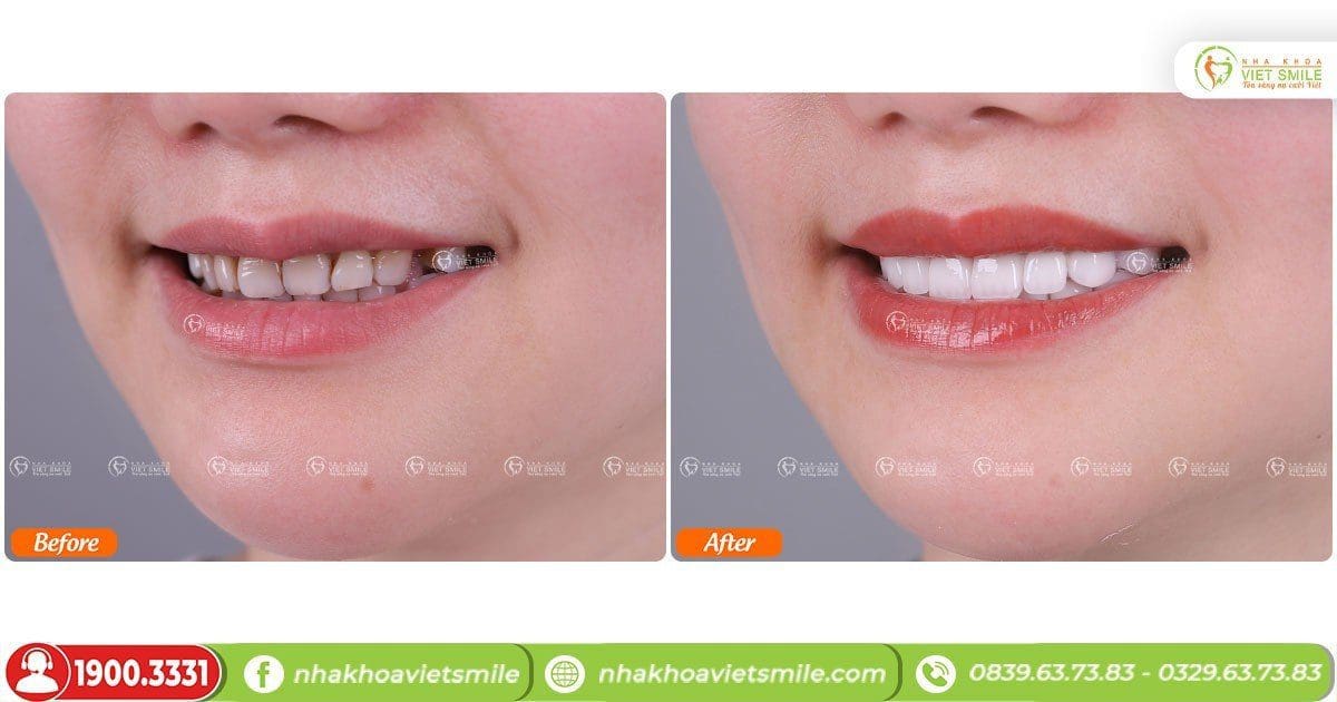 Bọc răng sứ cải thiện màu sắc răng