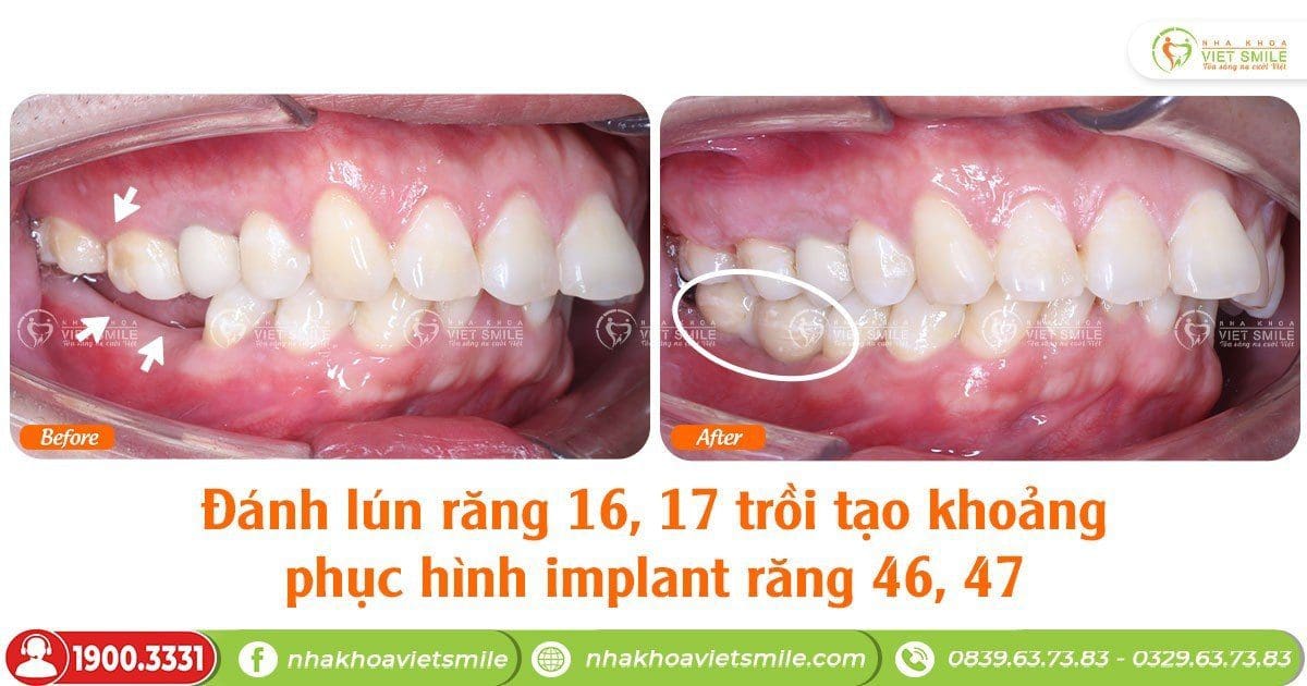 Đánh lún răng 16,17 trồi tạo khoảng phục hình implant răng 46, 47