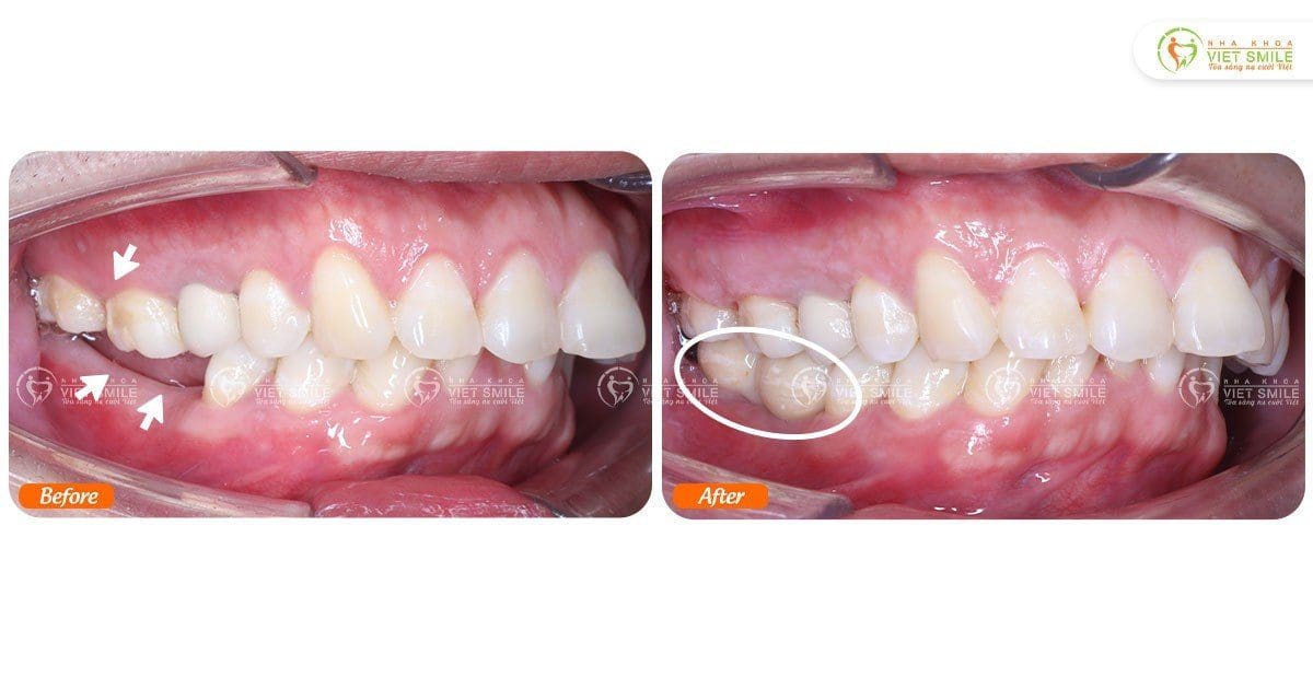 Đánh lún răng 16,17 trồi tạo khoảng phục hình implant răng 46, 47