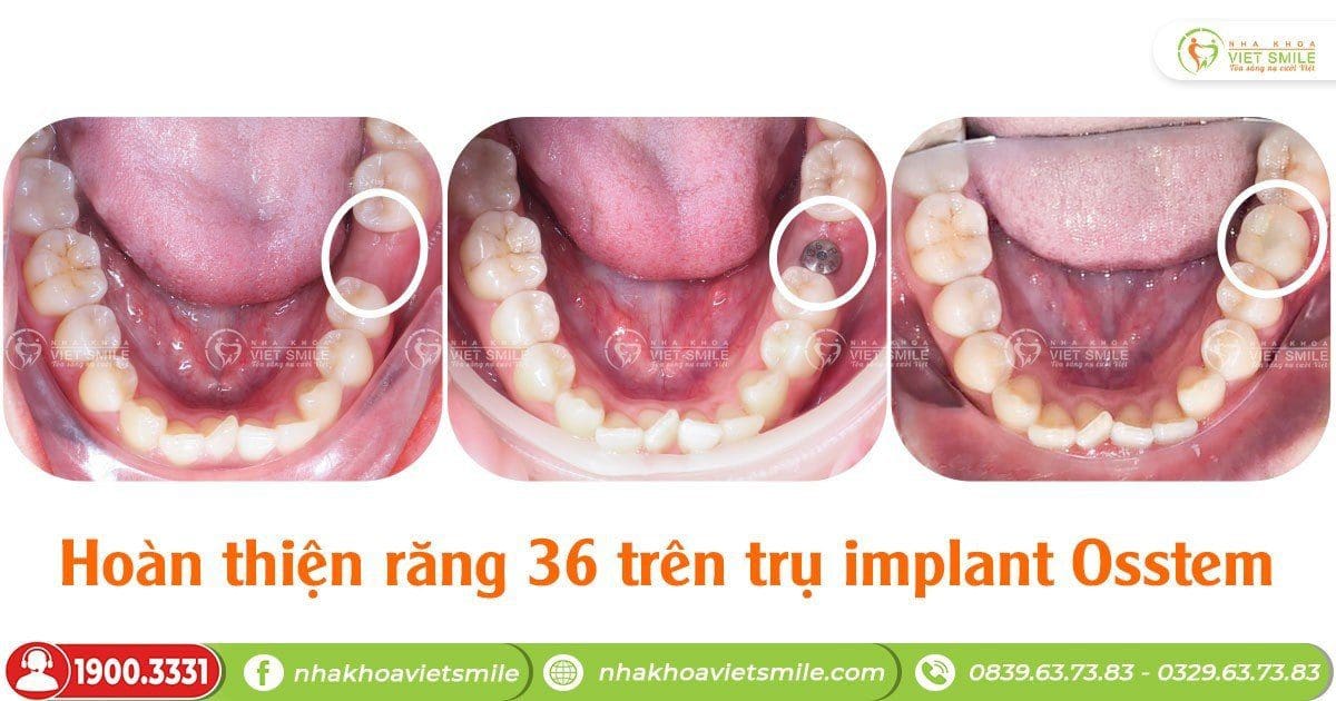 Hoàn thiện răng implant, thoải mái ăn nhai