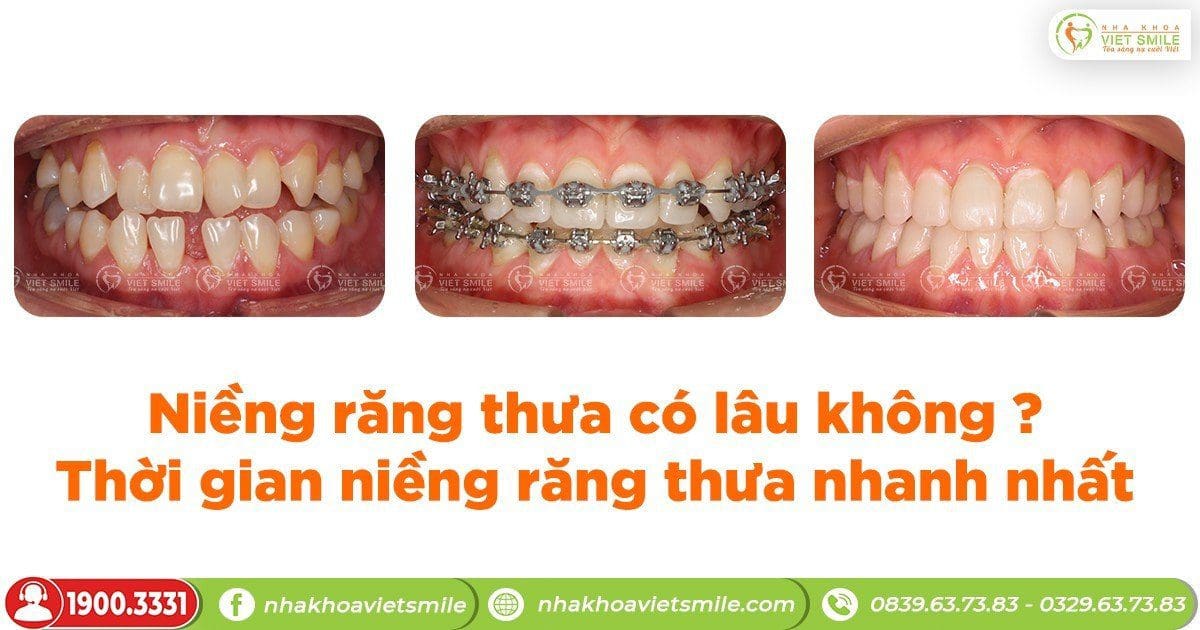Niềng răng thưa mất bao lâu?