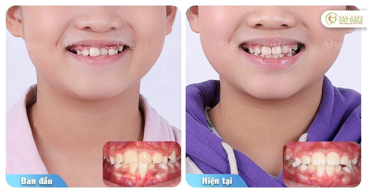 Niềng răng trẻ em cải thiện chen chúc, viêm lợi