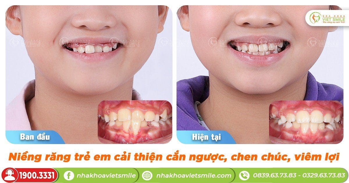 Niềng răng trẻ em khắc phục hiệu quả chen chúc, viêm lợi