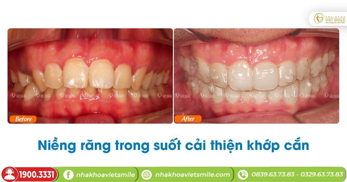 Niềng răng cải thiện khớp cắn