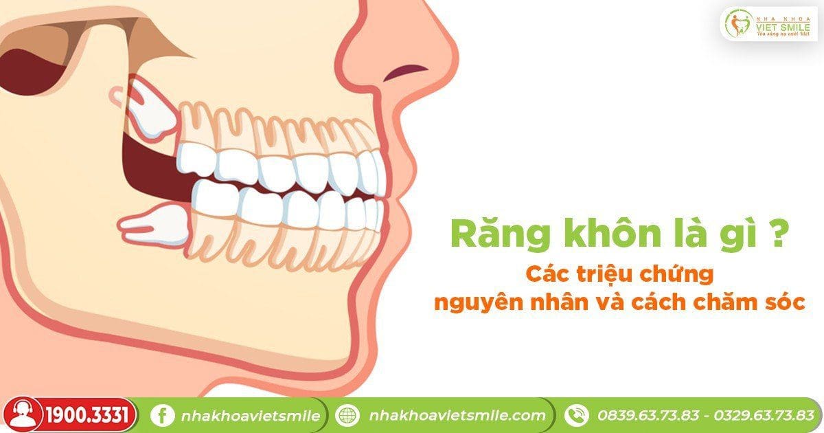 Răng khôn là gì? Các triệu chứng, nguyên nhân và cách chăm sóc