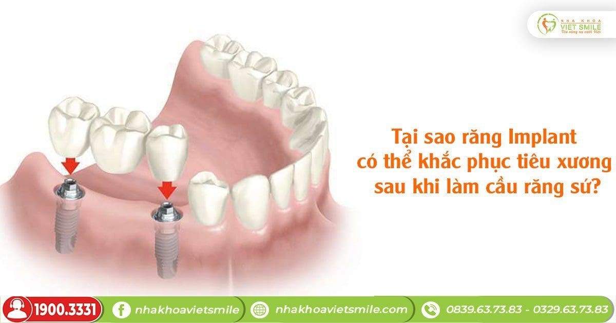 Tại sao răng Implant có thể khắc phục tiêu xương sau khi làm cầu răng sứ?
