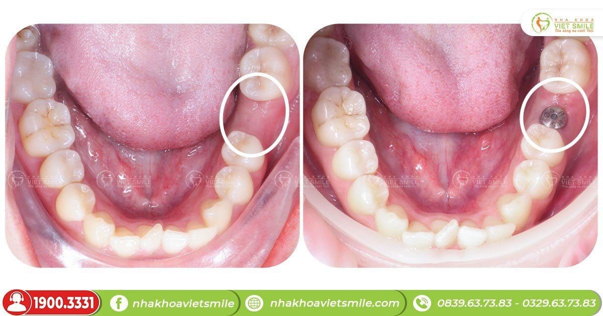 Trồng răng implant Osstem răng 36 