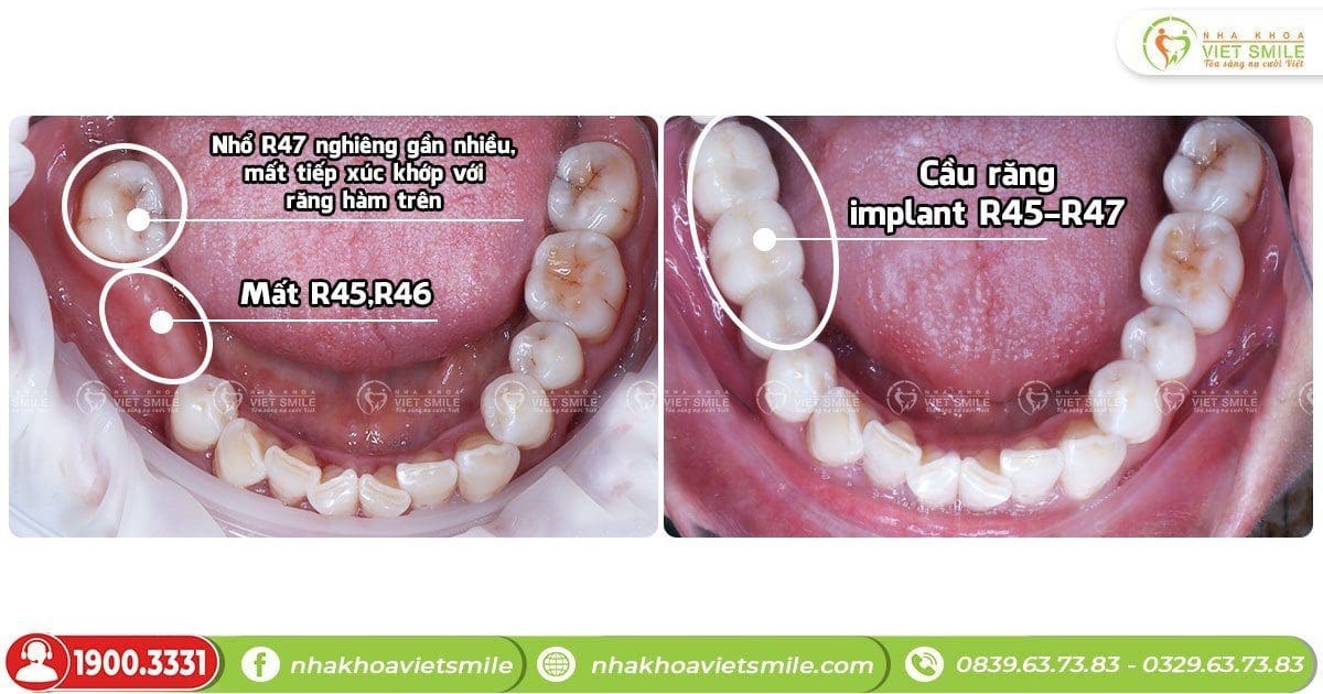 Răng implant