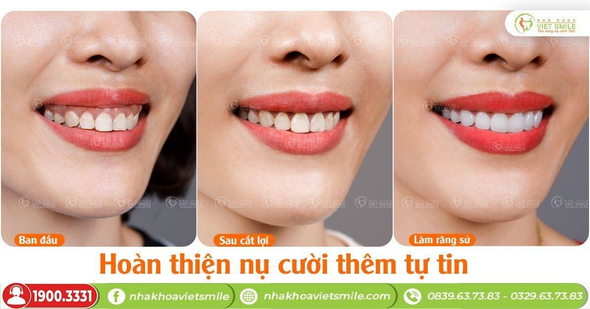 Làm răng sứ an toàn tại nha khoa Việt Smile
