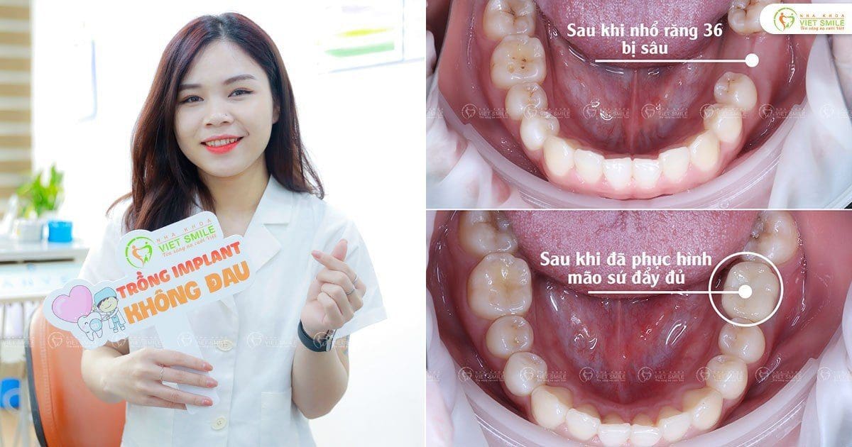 Cấy implant phục hồi răng 36 bị sâu vỡ
