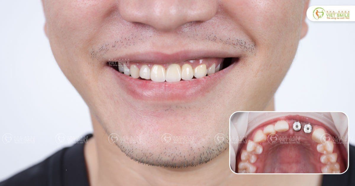 Trồng implant phục hình 2 răng cửa đã mất