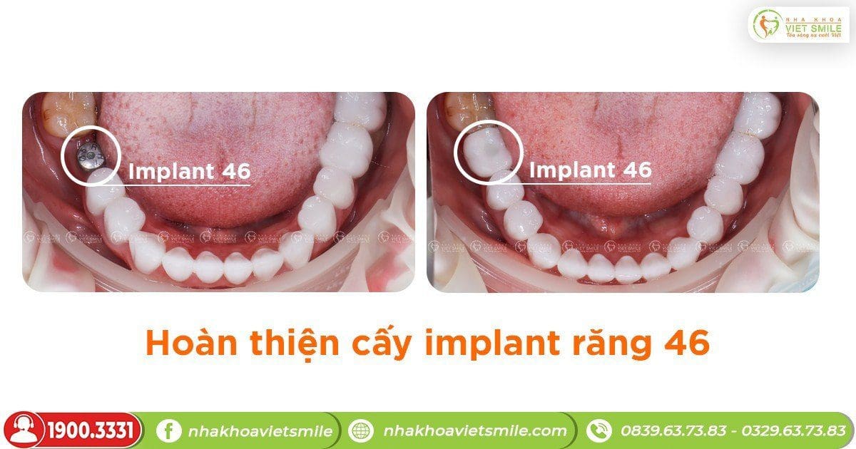Hoàn thiện cấy implant răng 46