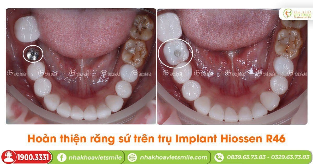 Hoàn thiện răng sứ trên trụ Implant Hiossen R46
