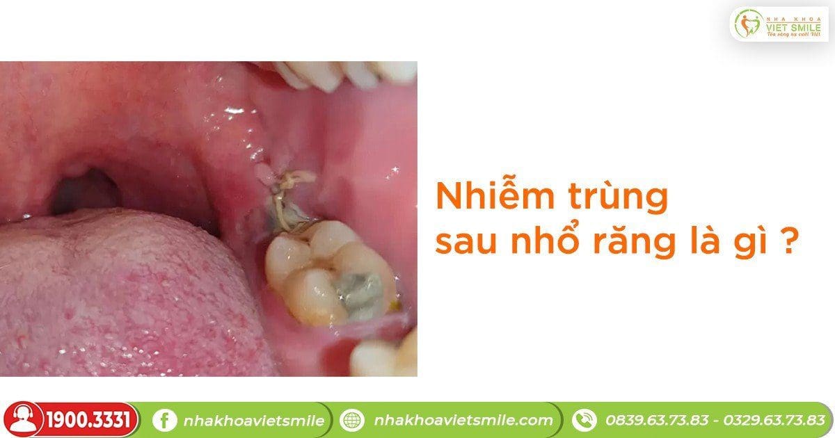 Nhiễm trùng sau khi nhổ răng là gì?
