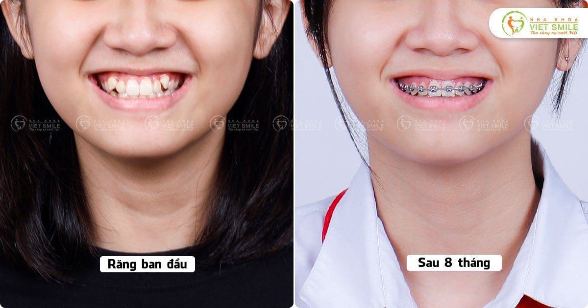 Niềng răng chen chúc thay đổi sau 8 tháng