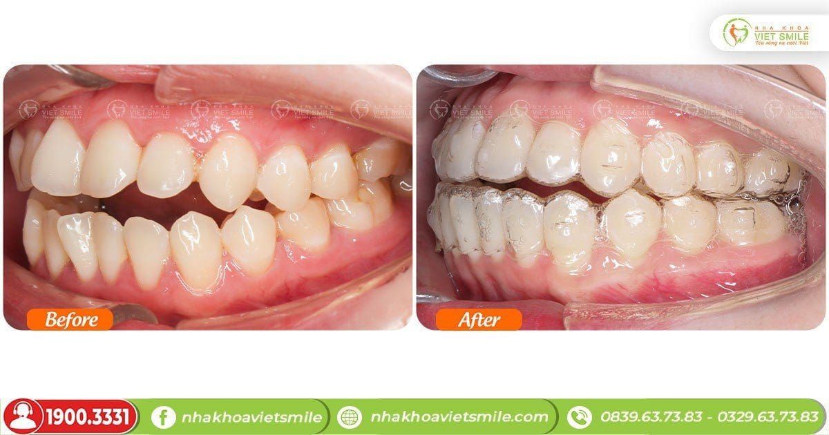 Thay đổi trước và sau 16 tháng niềng răng trong suốt