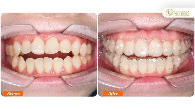 Thay đổi trước và sau 16 tháng niềng răng trong suốt