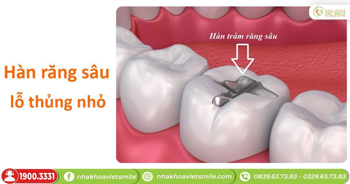 Quy trình trám răng lấy tuỷ
