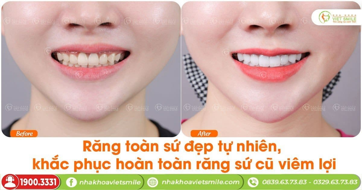 Răng toàn sứ đẹp tự nhiên, khắc phục hoàn toàn răng sứ cũ viêm lợi