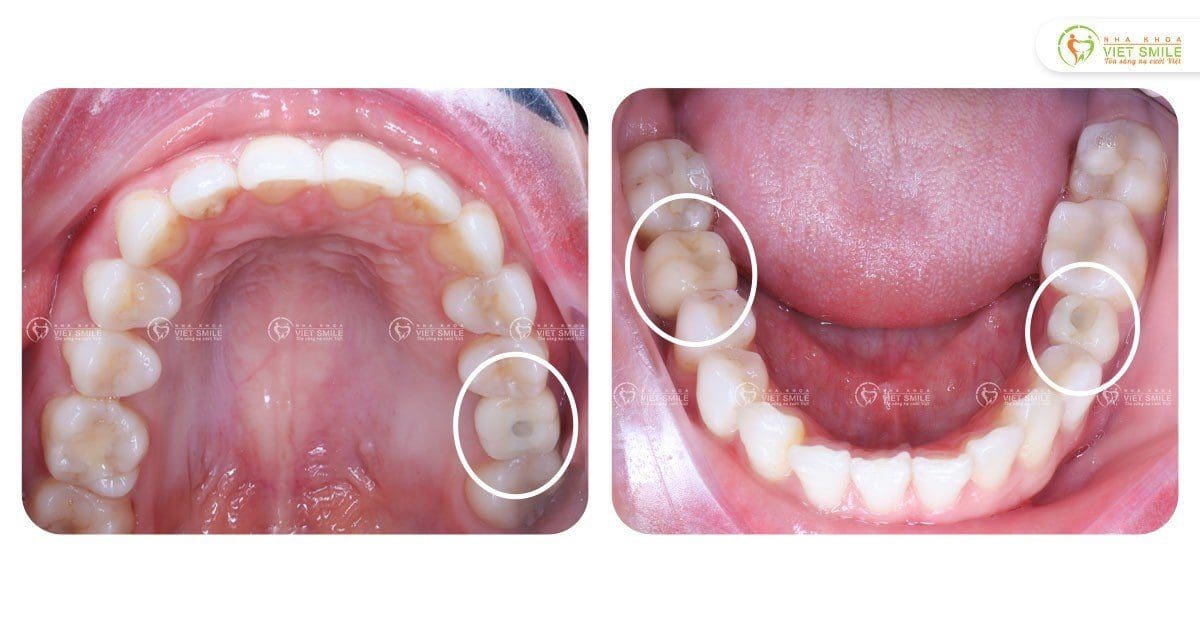 Trồng implant cho răng hàm đã mất