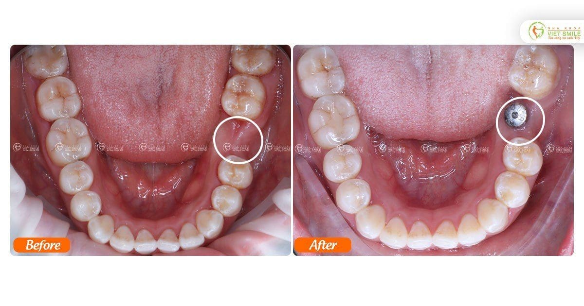 Trồng implant răng số 6