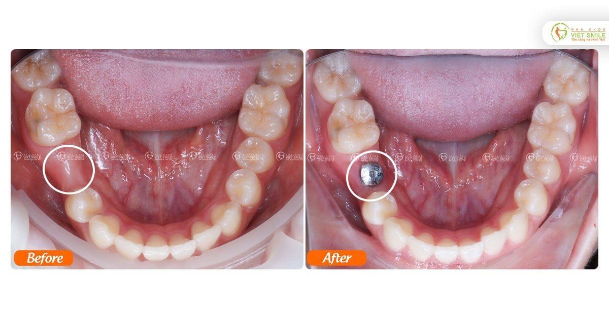 Trồng implant răng 45 cải thiện tình trạng mất răng