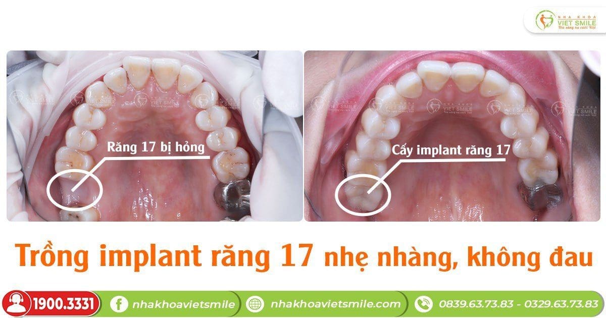 Trồng răng implant 17 nhẹ nhàng, không đau