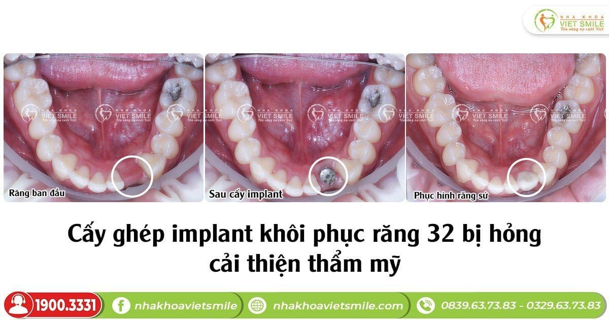Cấy implant khôi phục răng 32 bị hỏng cải thiện thẩm mỹ