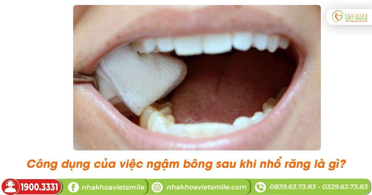Công dụng của việc ngậm bông sau khi nhổ răng là gì?