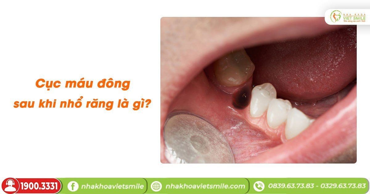 Cục máu đông sau khi nhổ răng là gì?