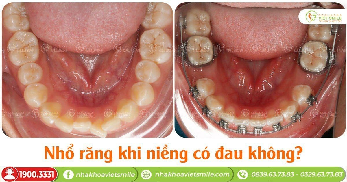 Nhổ răng khi niềng có đau không?