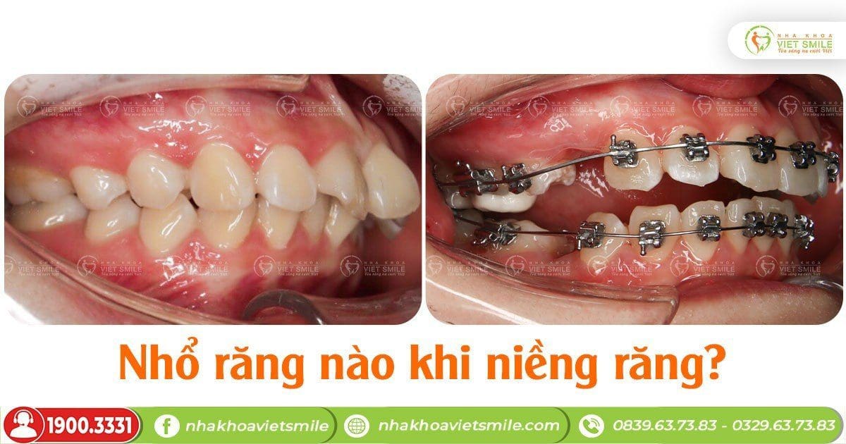 Nhổ răng nào khi niềng răng?