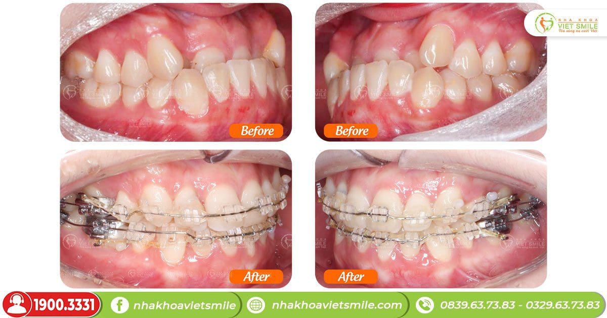 Niềng răng cải thiện hàm răng xấu do khấp khểnh, móm