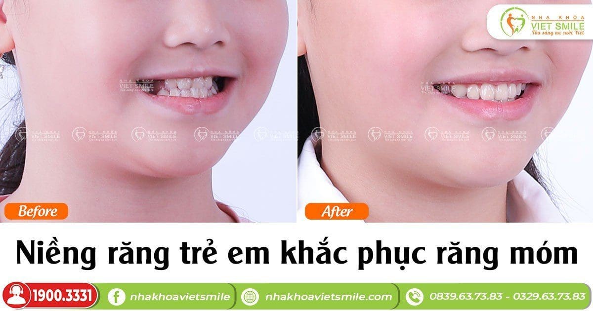 Niềng răng trẻ em, khắc phục khớp cắn ngược do răng, do xương