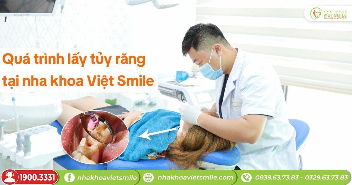Quá trình lấy tủy răng tại nha khoa Việt Smile