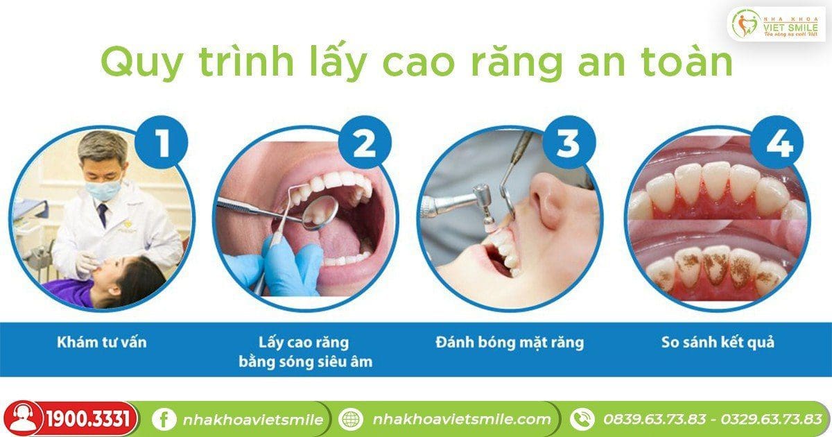 Quy trình lấy cao răng an toàn