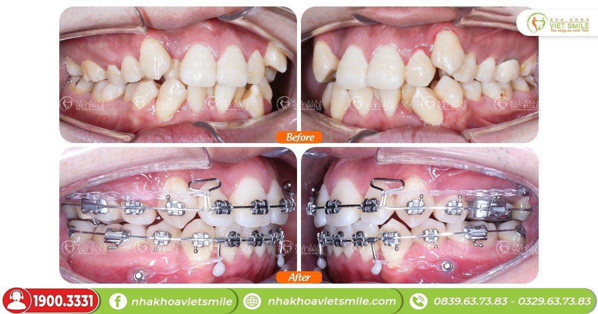 Niềng răng cải thiện chen chúc sau hơn 1 năm gắn mắc cài