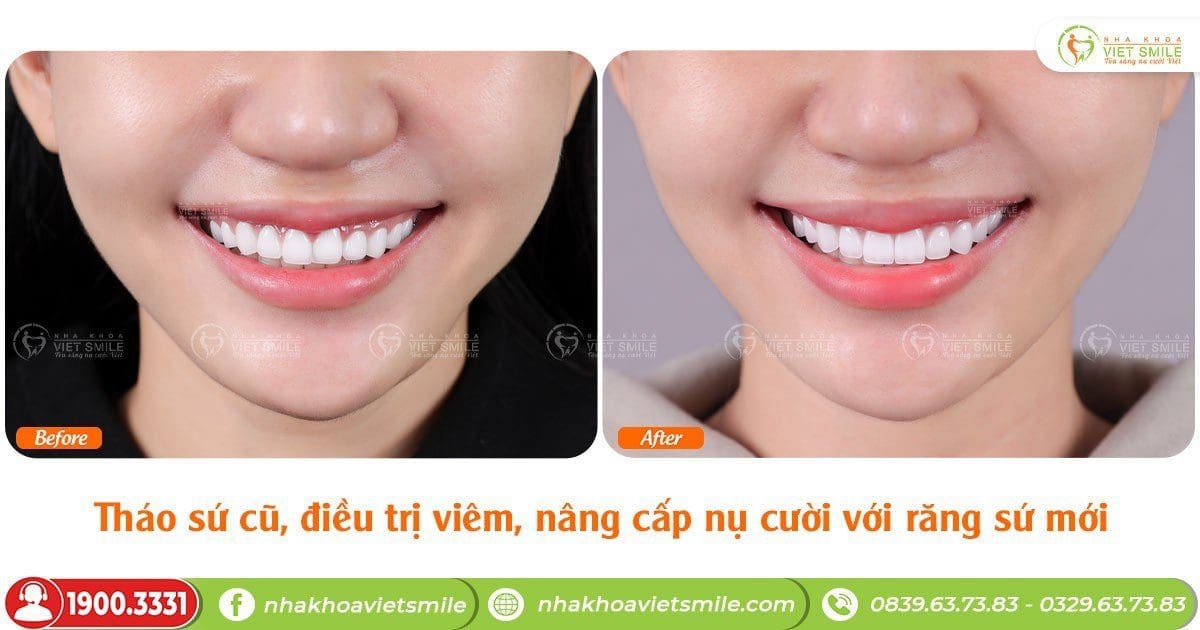 Tháo sứ cũ, điều trị viêm, nâng cấp nụ cười với răng sứ mới