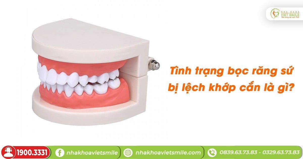 Tình trạng bọc răng sứ bị lệch khớp cắn là gì?