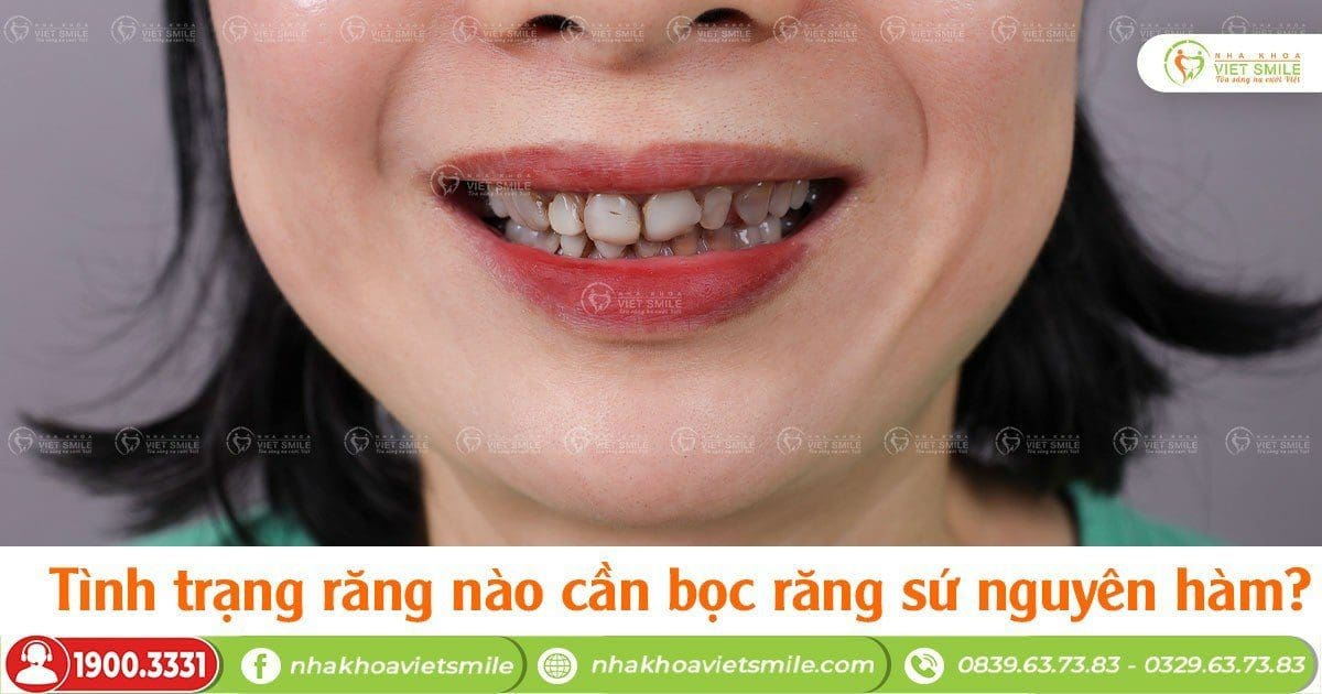 Tình trạng răng nào cần bọc răng sứ nguyên hàm?