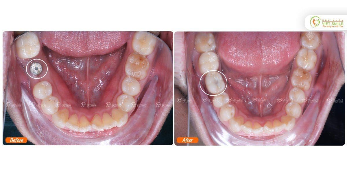 Trồng implant phục hình răng số 6 đã mất