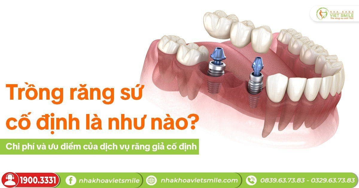 Trồng răng sứ cố định là như nào? Chi phí và ưu điểm của dịch vụ răng giả cố định