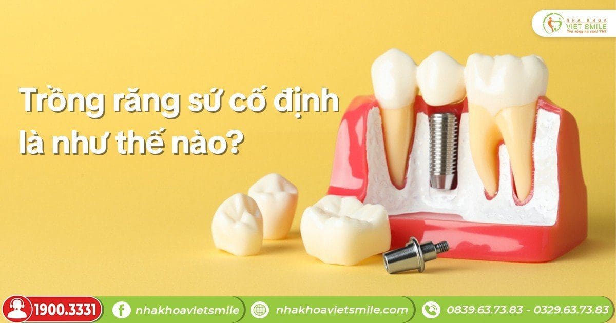 Trồng răng sứ cố định là như thế nào?