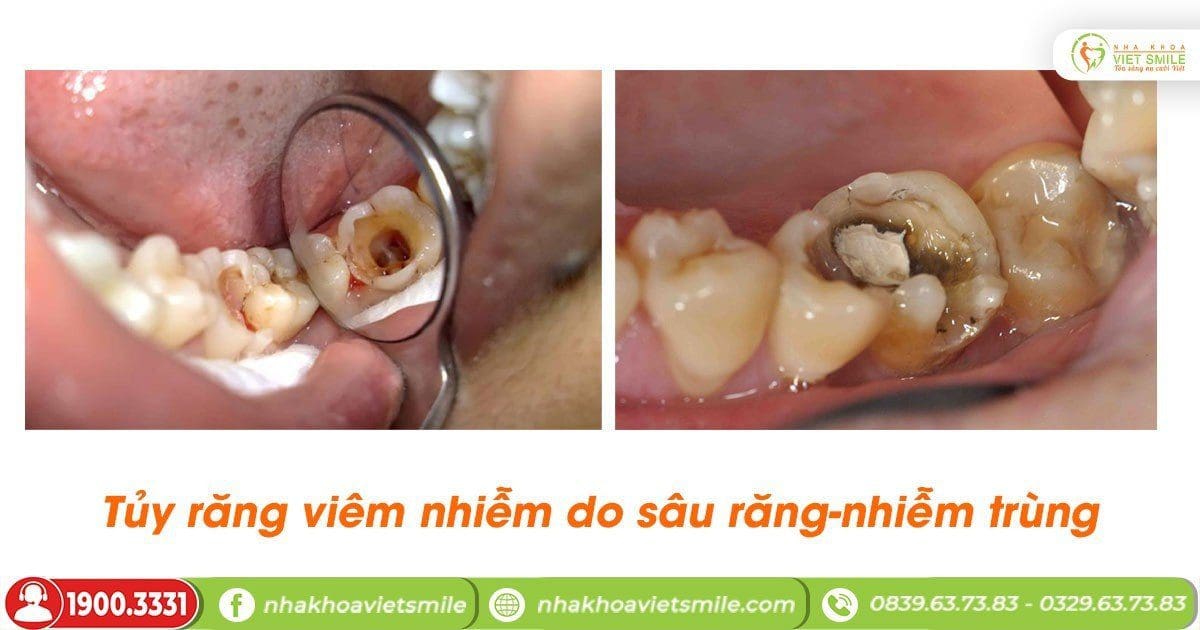 Tủy răng viêm nhiễm do sâu răng-nhiễm trùng