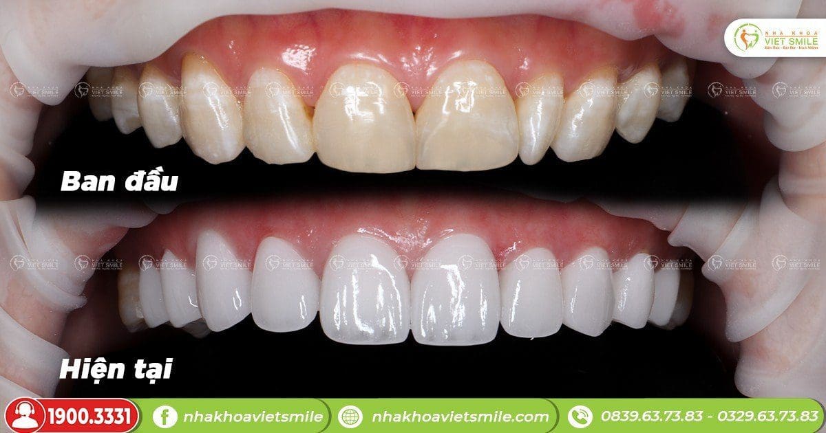 Bọc sứ khắc phục răng không đều màu