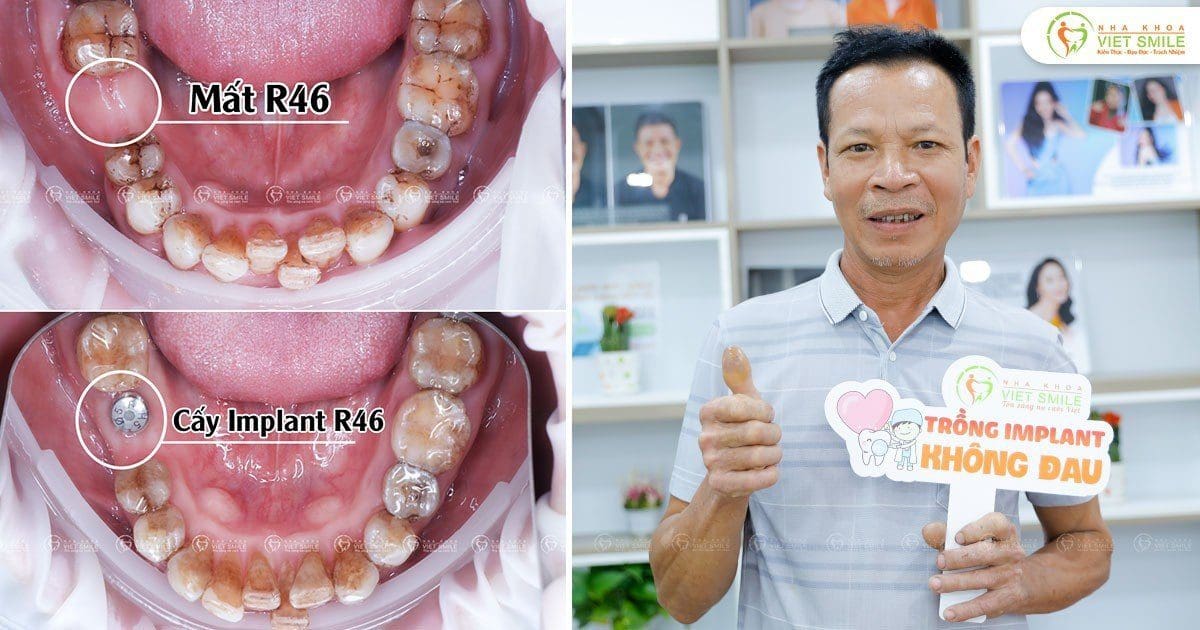Cay implant khoi phuc phuc rang mat cg5154